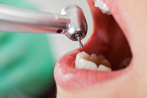 Best Emergency Wisdom Teeth Removal in Crescent City, FL